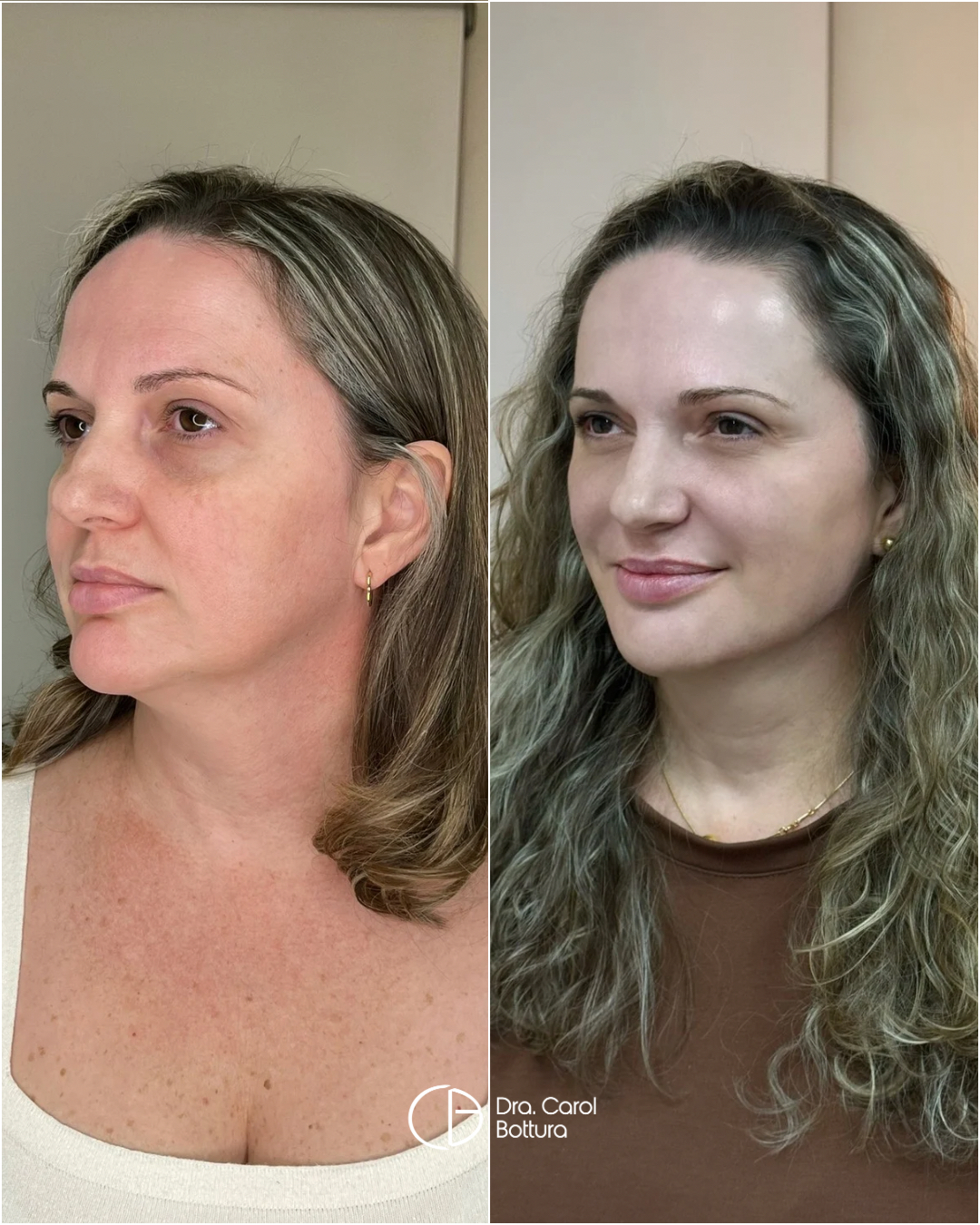 Antes e depois — Quero valorizar meus traços