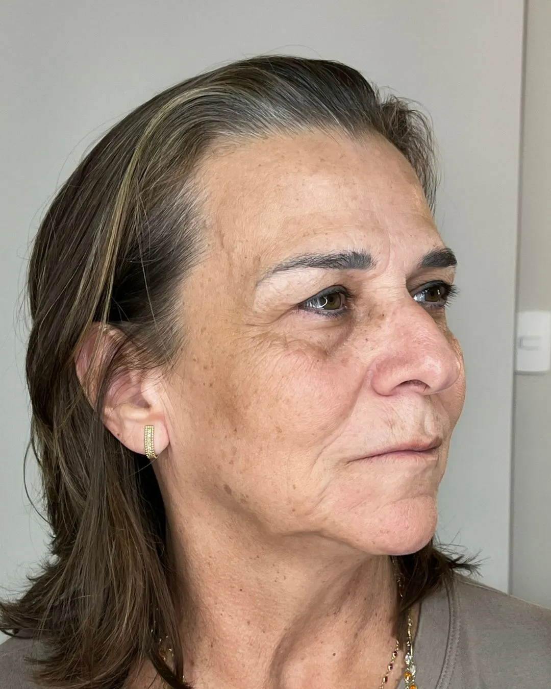 M., 42 anos — antes de Botox + Preenchimento labial