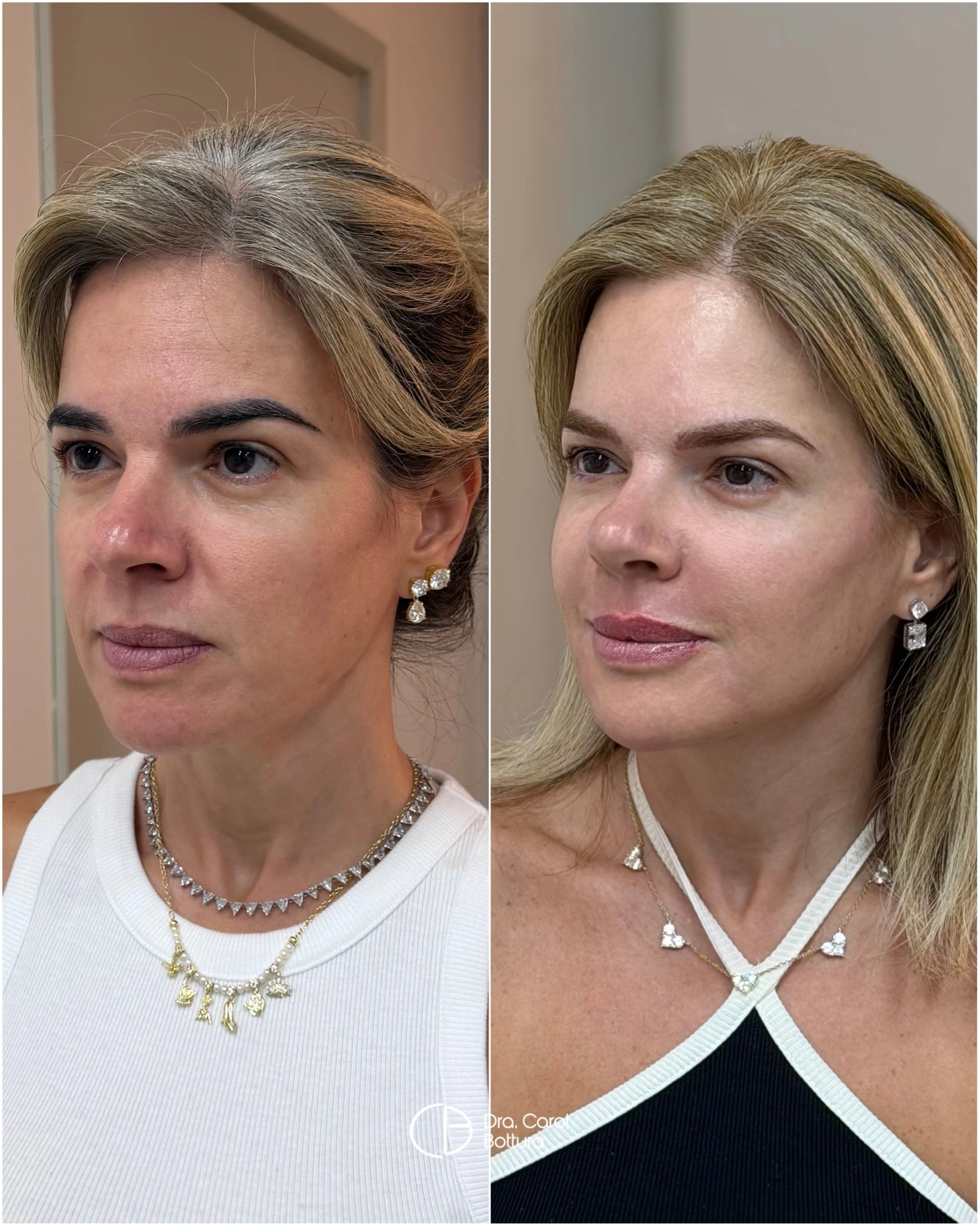 Antes e depois — Quero prevenir o envelhecimento